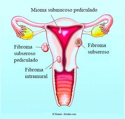 fibroma-del-útero