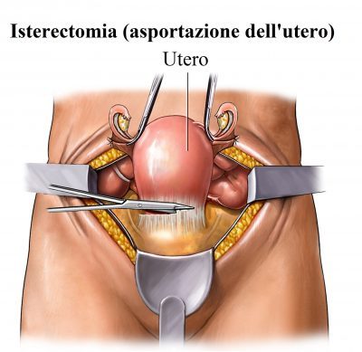 histerectomía