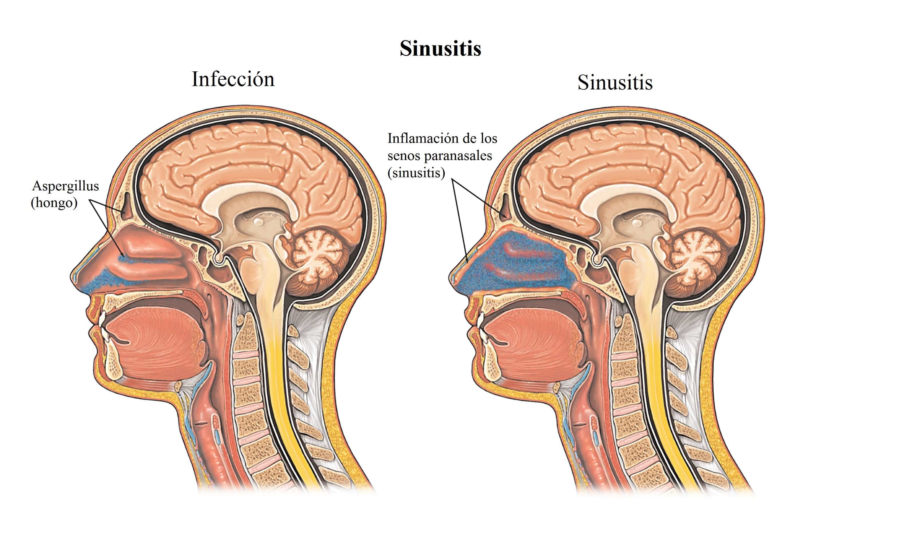 sinusitis-dolor-nariz-cabeza