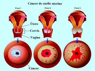 carcinoma cervical
