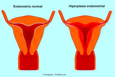 tratamiento-para-endometritis