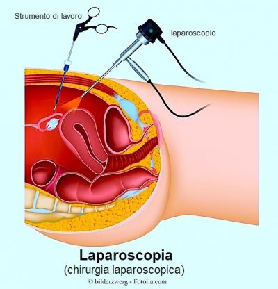 Laparoscopia-tumor-de-ovarios