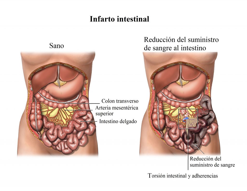 Infarto-intestinal
