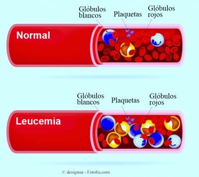 leucemia-sangre