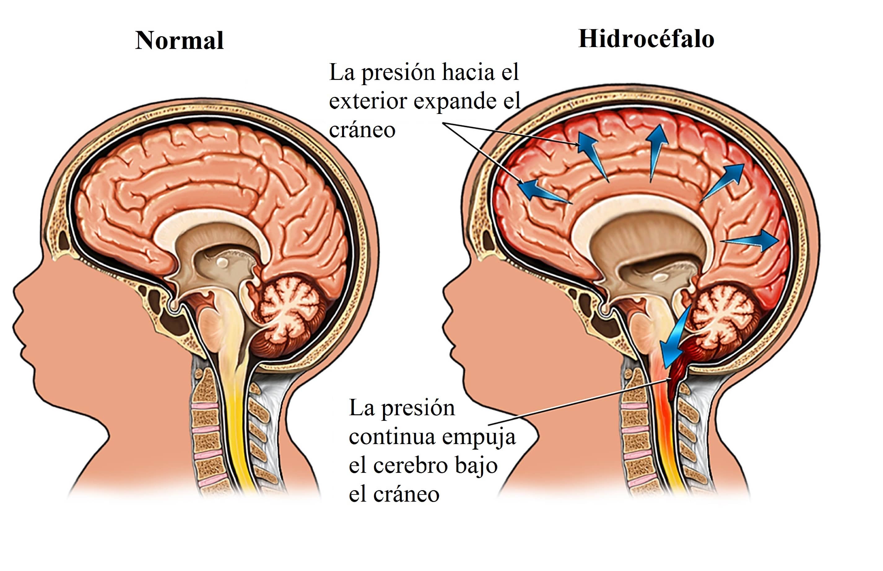 cerebro-hidrocefalia