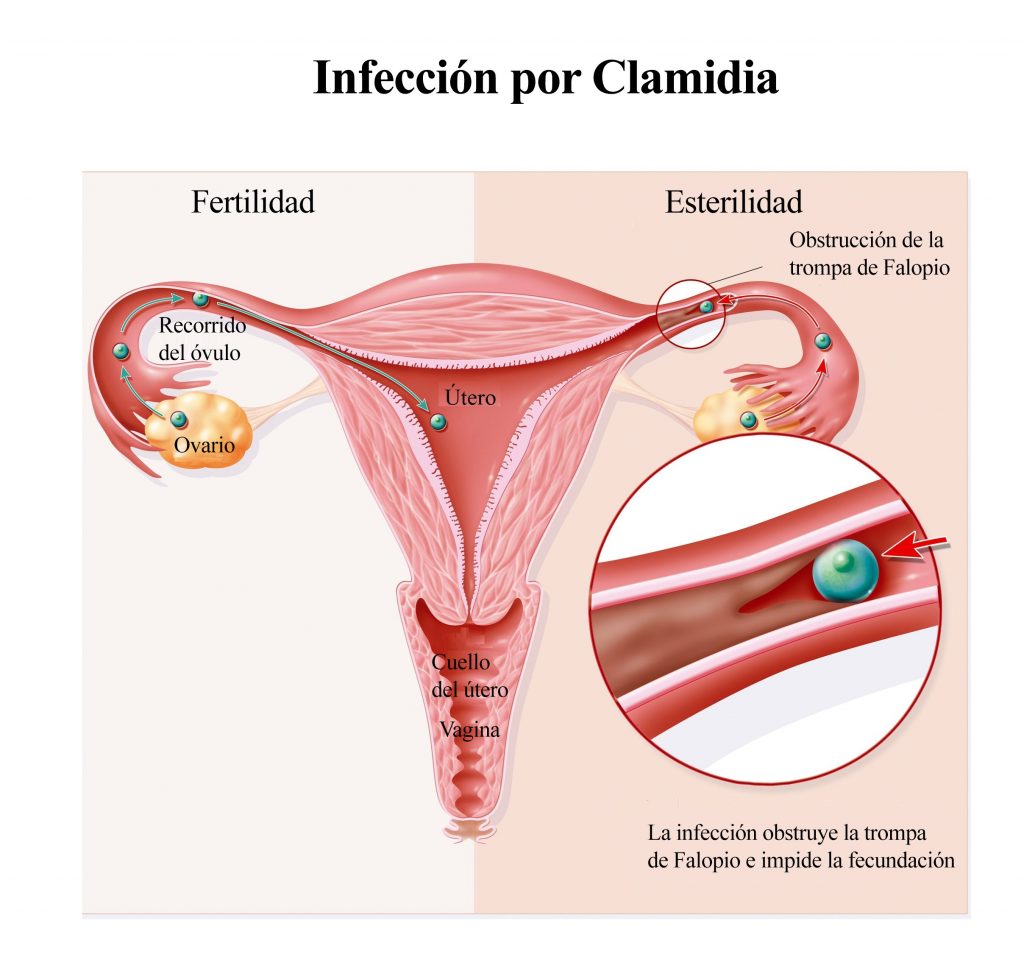 clamidia-fertilidad-infertilidad-esterilidad