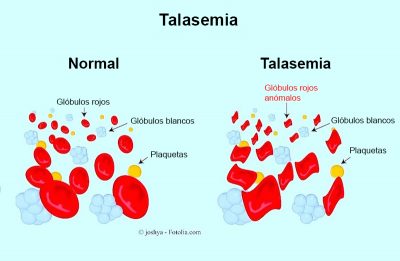 talasemia-sangre
