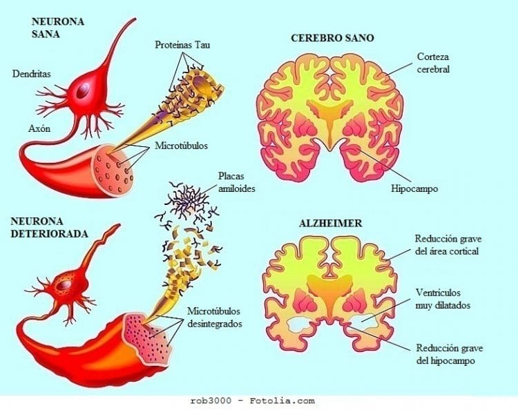 enfermedad de Alzheimer, cerebro, nervios, corticales, ventrículos