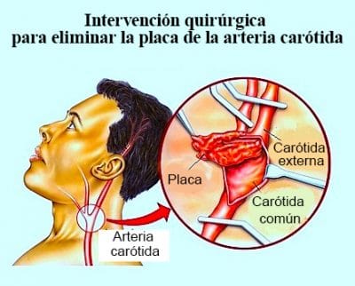 Intervencion quirurgica para eliminar la placa de la arteria carotida