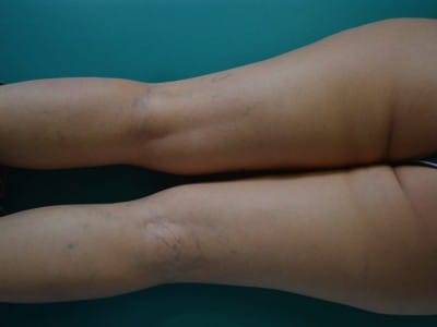 tema chorro Implementar Vasos sanguíneos reventados en las piernas: tratamiento, remedios y  prevención