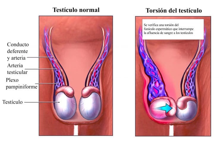 torsion de testiculo