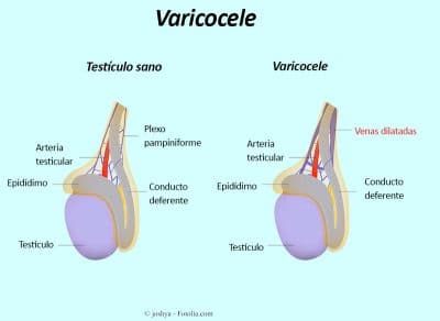 varicocele testicular