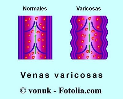 Venas varicosas