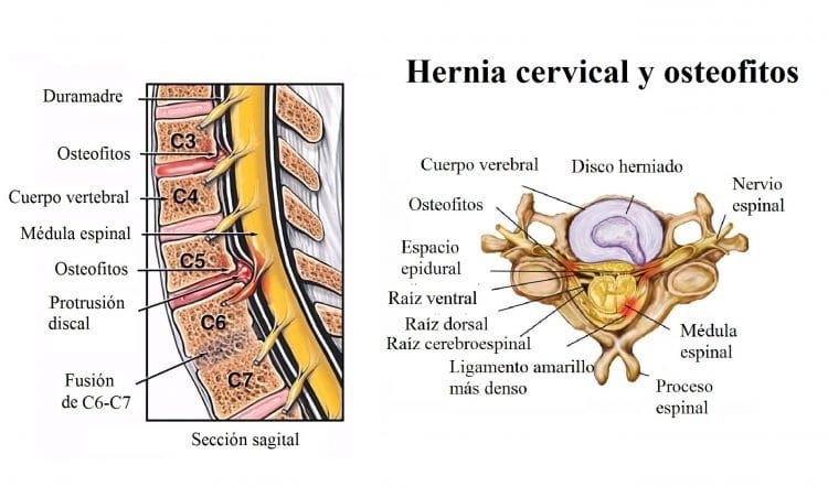 hernia cervical y osteofitos