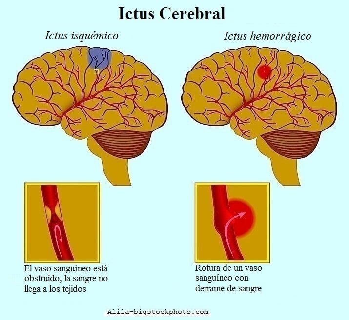 Ictus Cerebral Isquemico O Hemorragico Sintomas Causas Derrame Secuelas ...