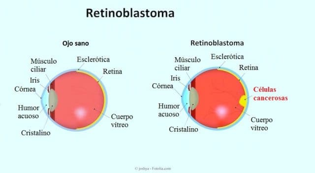 Retinoblastoma del ojo