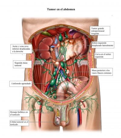 tumor en el abdomen