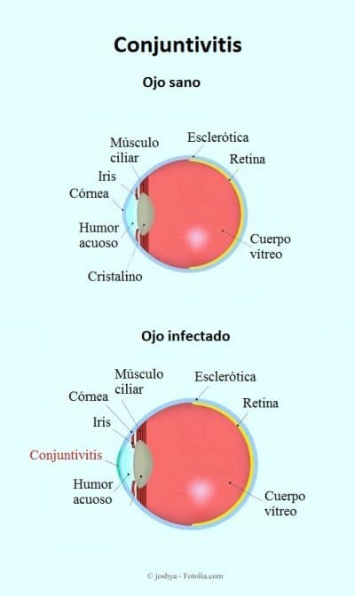 Conjuntivitis, ojo infectado