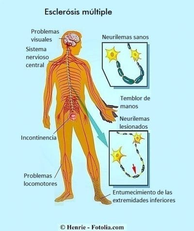 esclerosis múltiple, causas, síntomas
