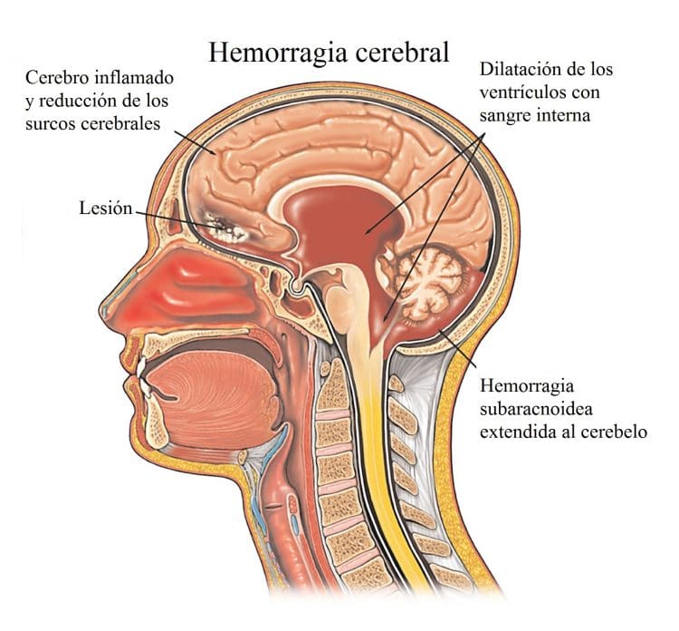 Hemorragia cerebral, hematoma