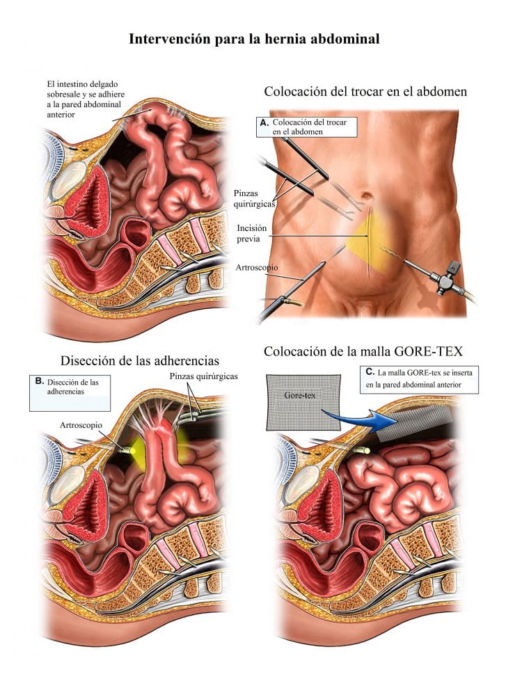 Intervención, hernia abdominal, cirugía, laparoscópica