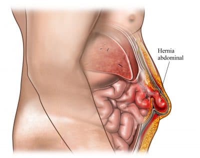 Hernia abdominal, causas, abdomen
