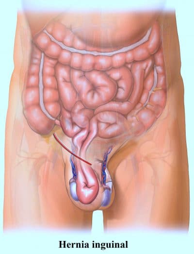 Hernia inguinal indirecta testículos
