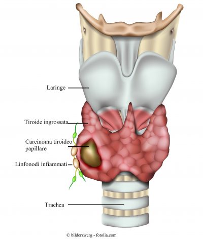 carcinoma de tiroides