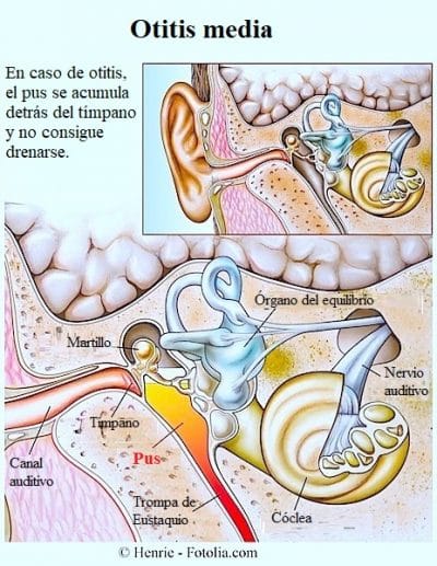 Otitis media, infección, pus, oído, niños