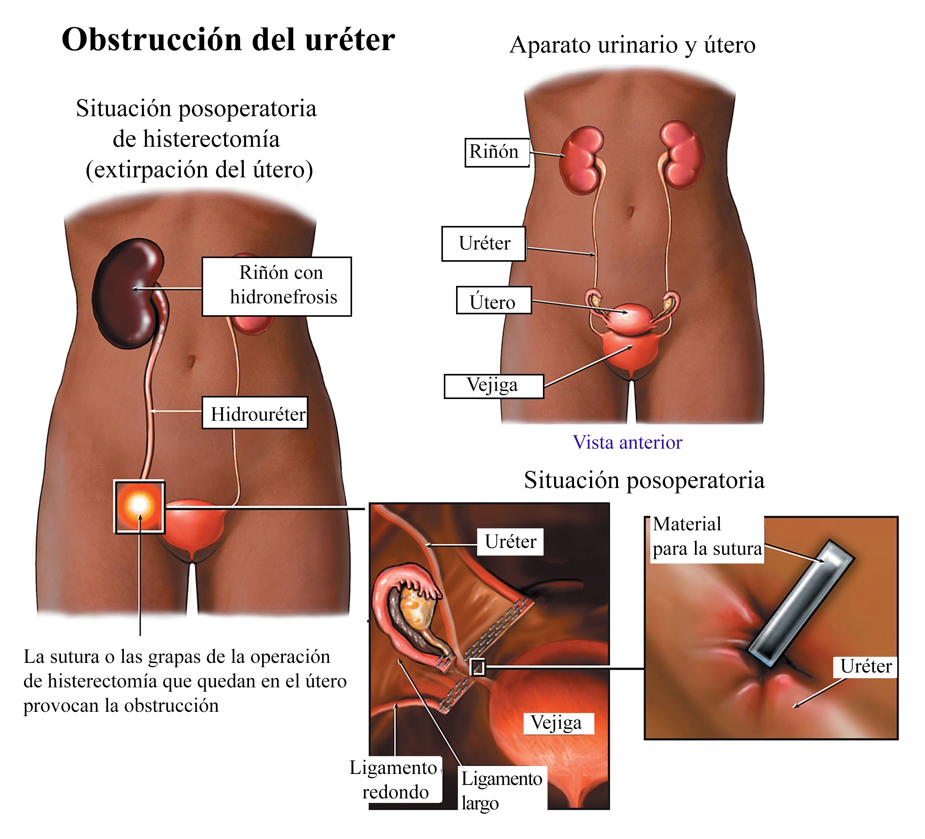 Estenosis uretral, obstrucción, hidronefrosis