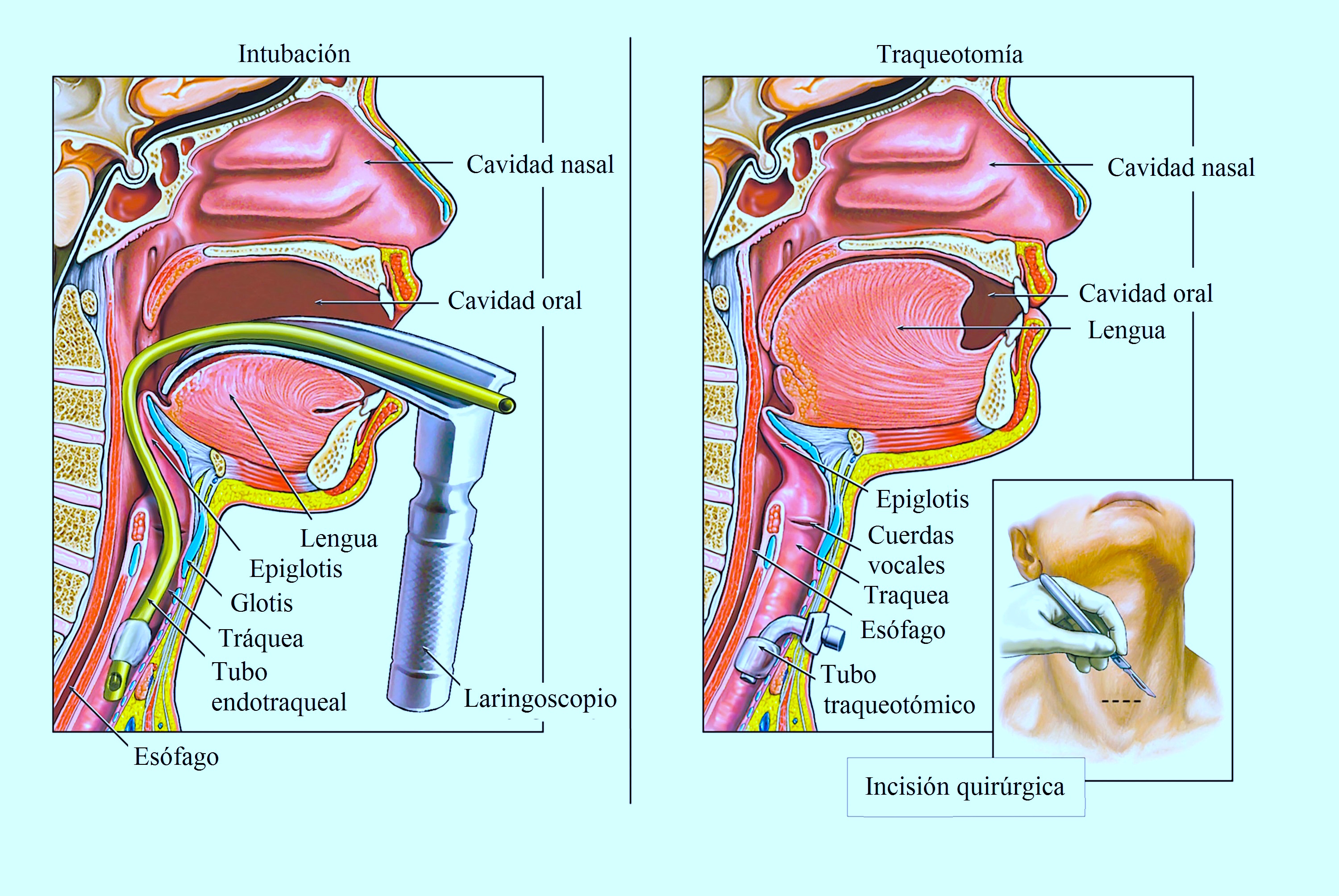 traqueotomía, intubación, cáncer de tiroides