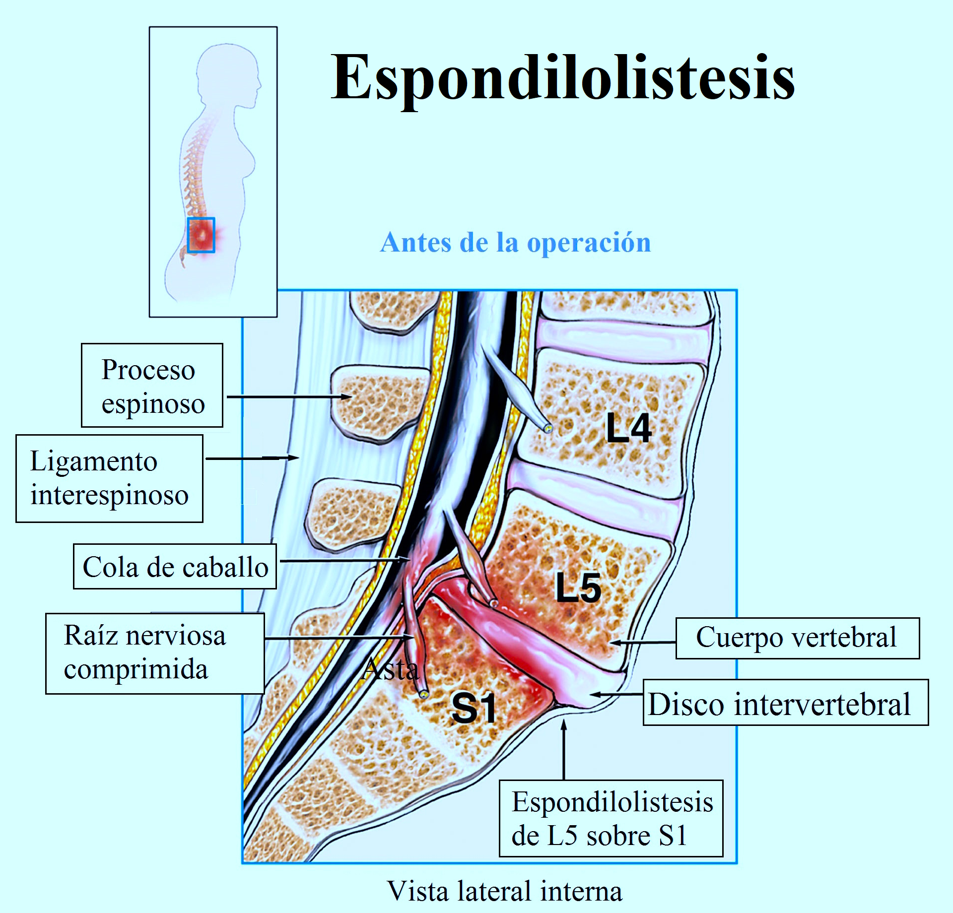Espondilolistesis
