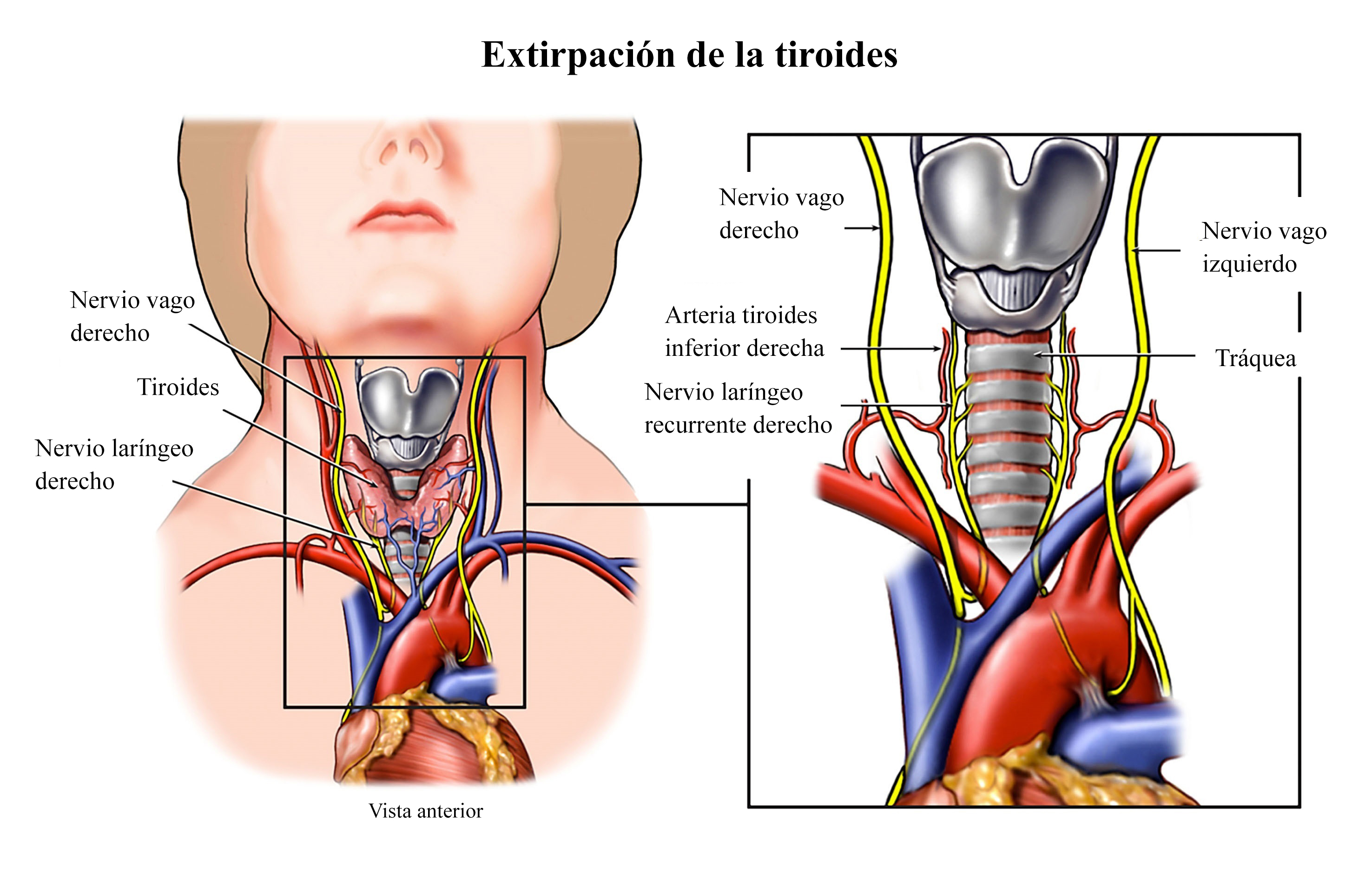extirpación tiroides