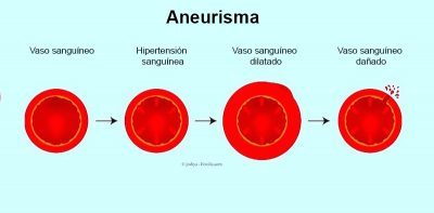 aneurisma, presión alta, ruptura, arteria, sangre