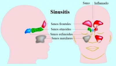 Sinusitis, senos nasales