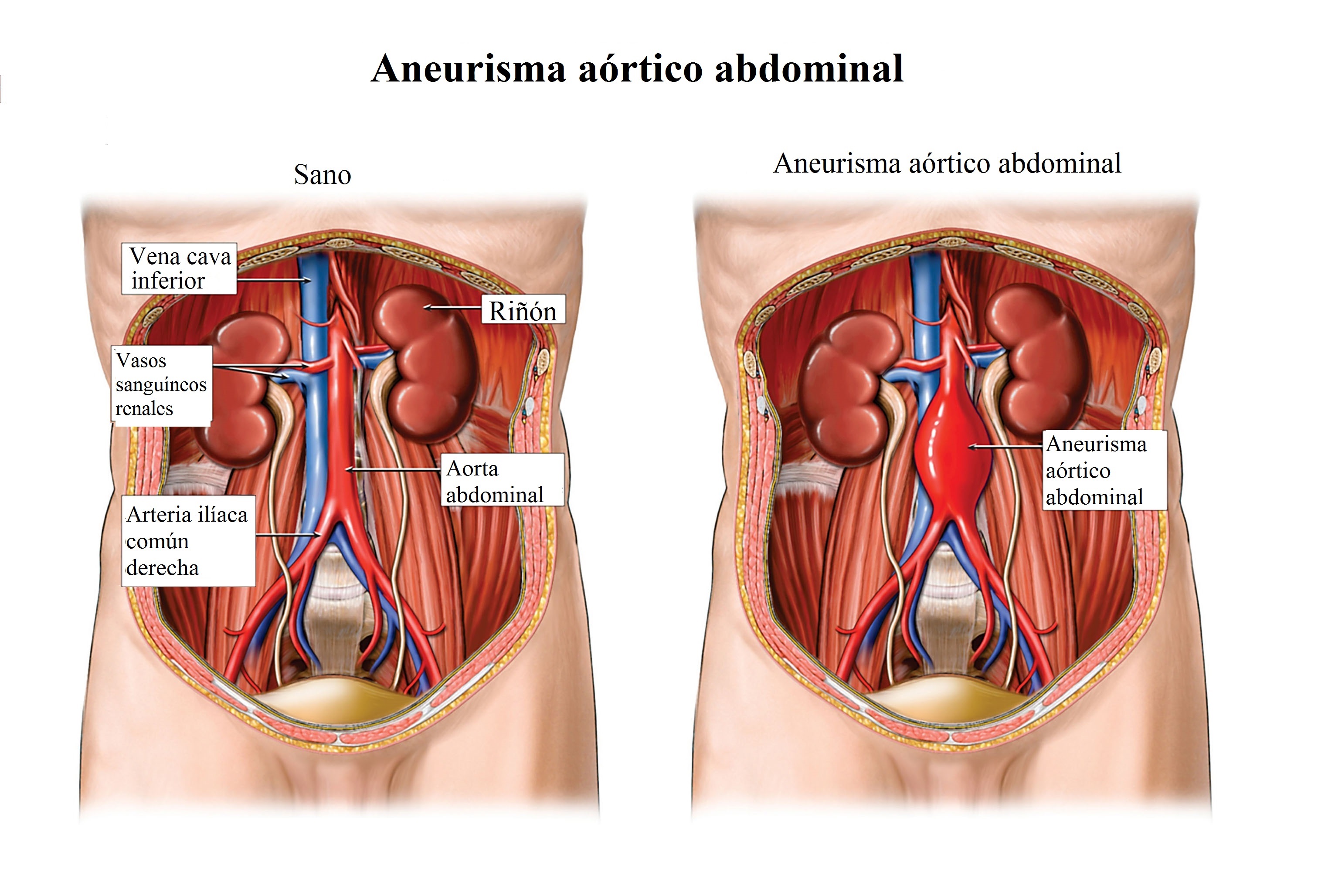 Aneurisma, aorta, abdominal, arteria