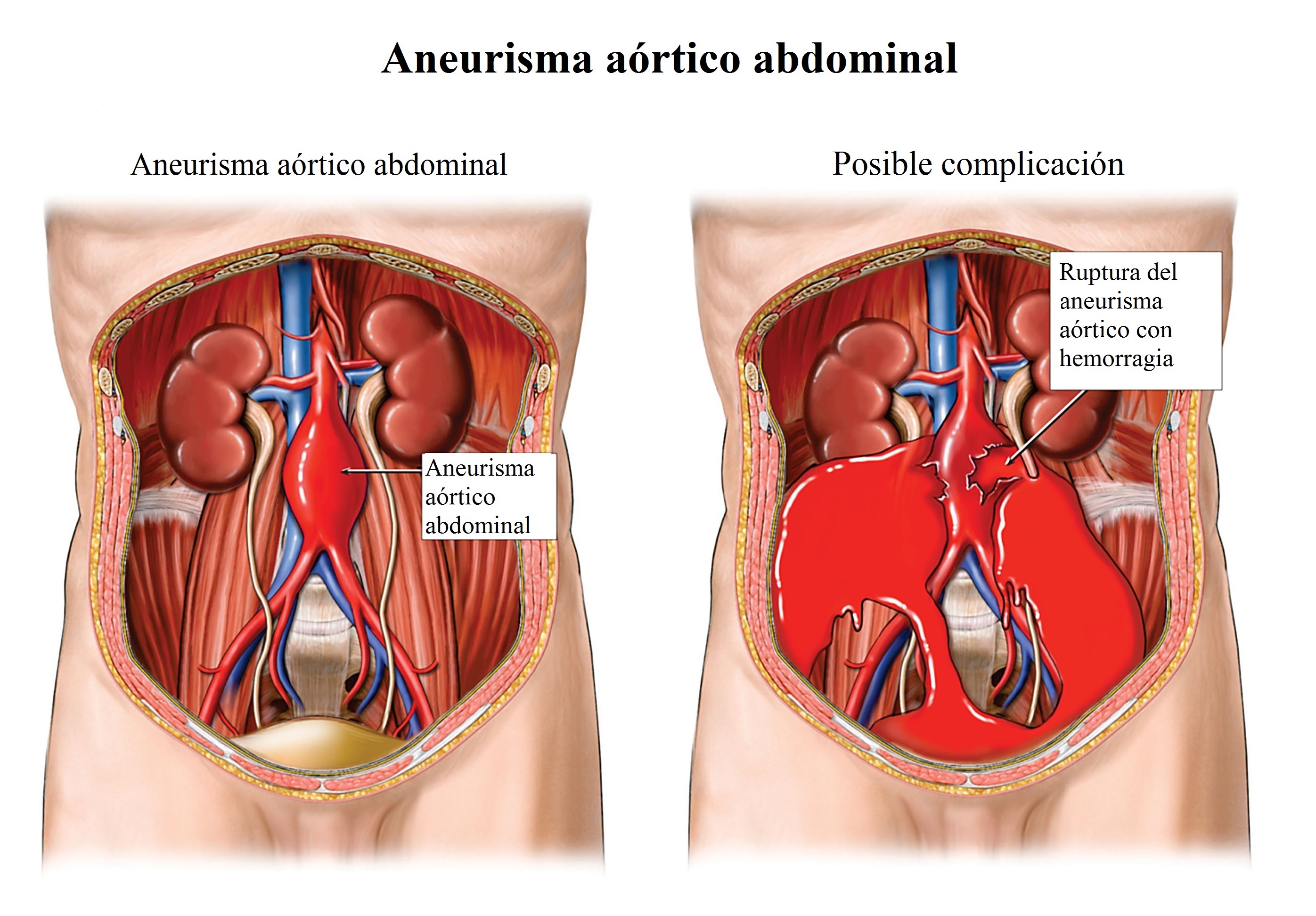 Ruptura del aneurisma, aorta, abdominal