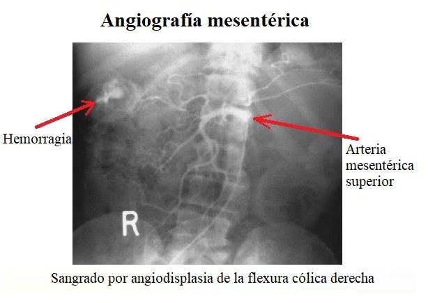 angiografía mesentérica