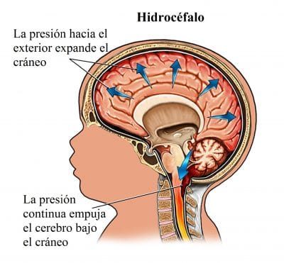 cerebro, hidrocéfalo