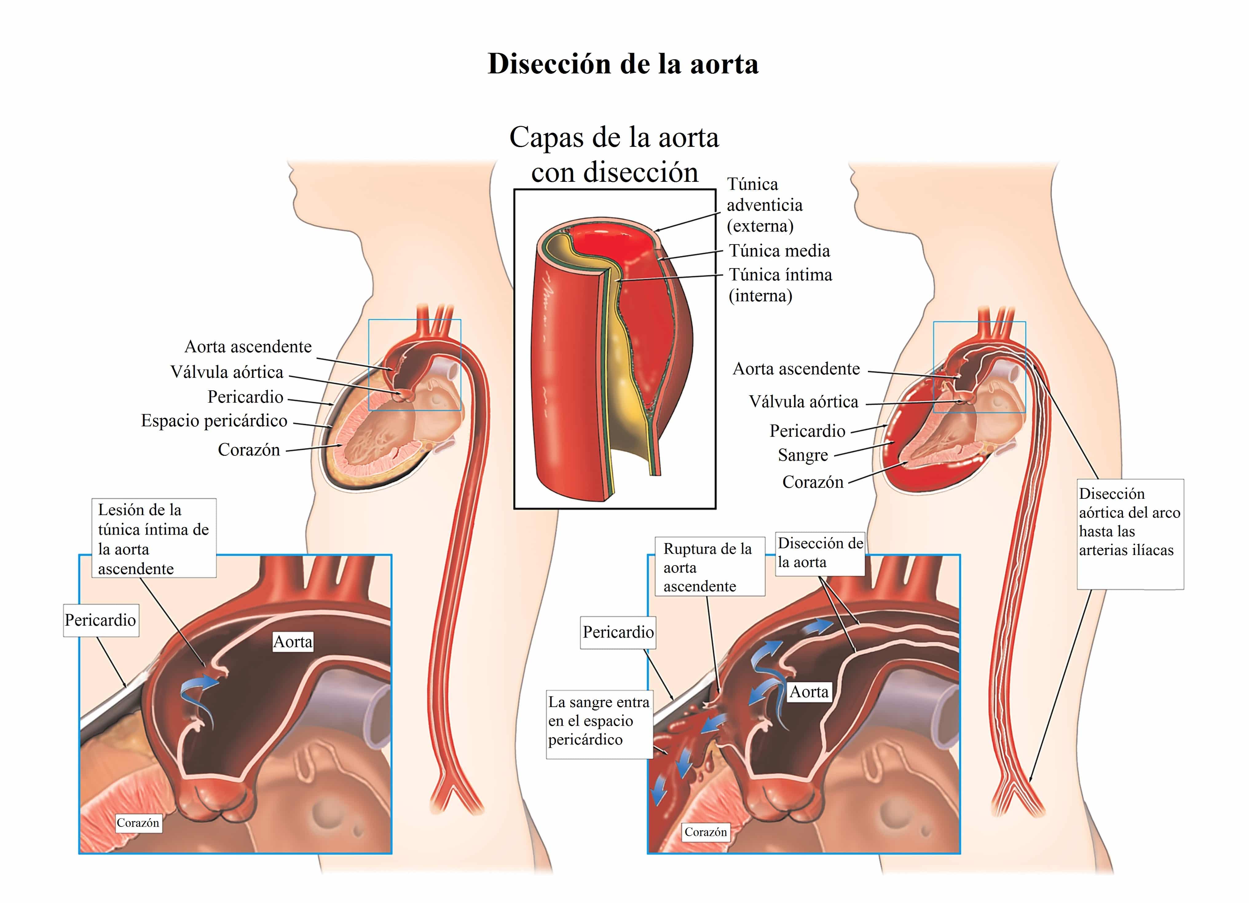 disección de aorta, sangre, aorta