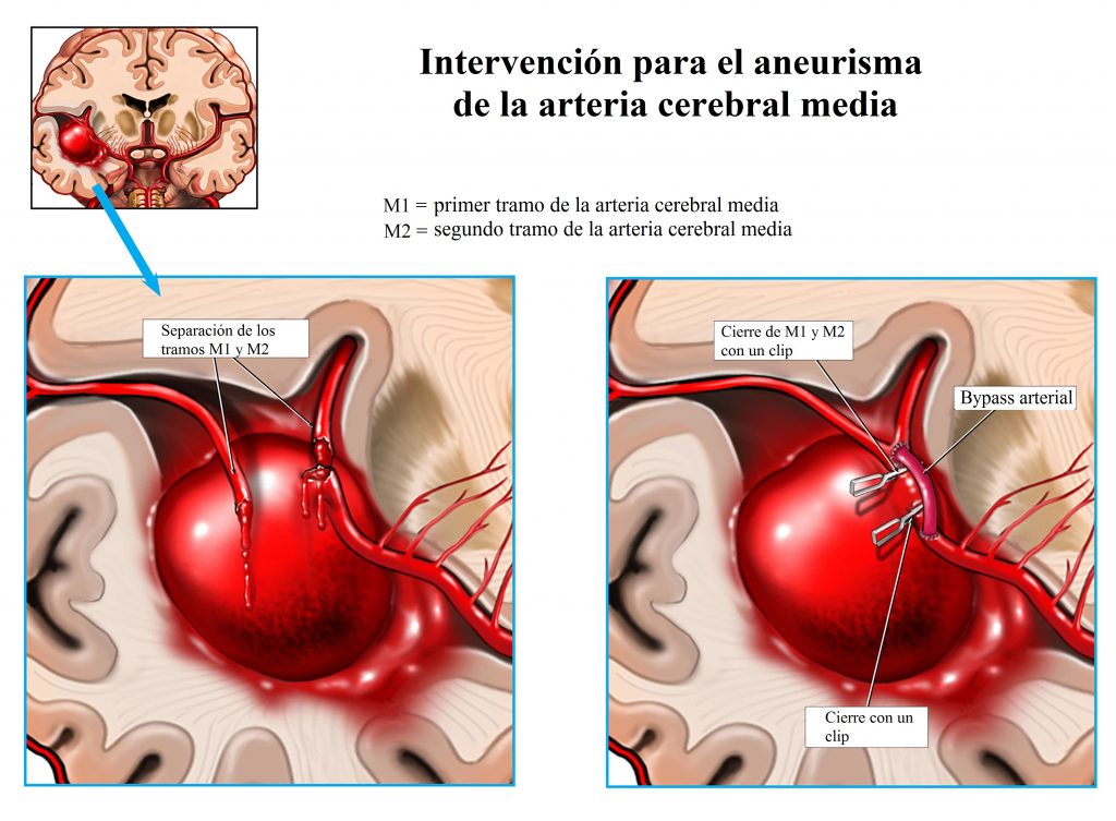 Intervención de aneurisma de la arteria - © alamy.com