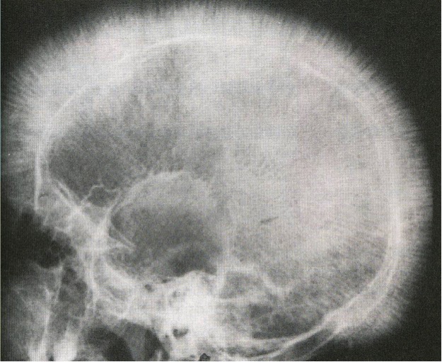 radiografía, cráneo en cepillo