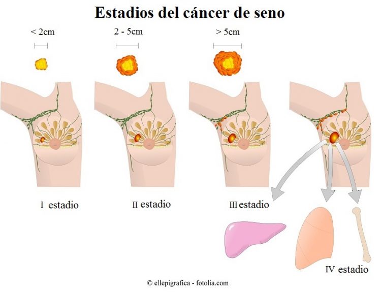 etapas, cáncer de mama
