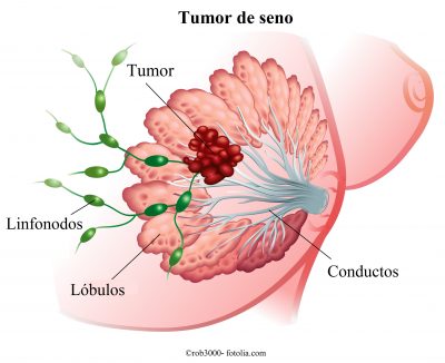 cáncer de mama, ductos, lóbulos