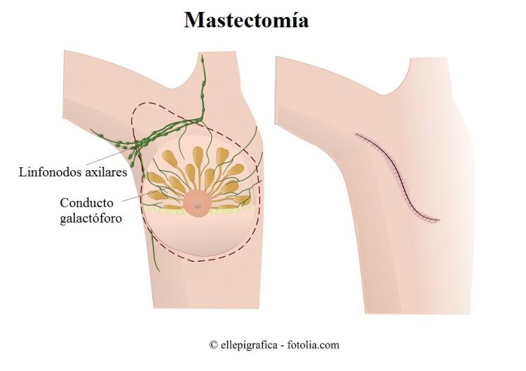 mastectomía, cáncer de mama