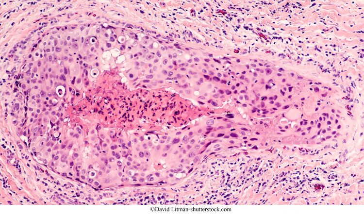 Bopsia de mama, carcinoma ductal de grado 3, necrosis comedónica