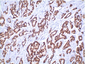 Carcinoma de grado 1, receptores estrogénicos