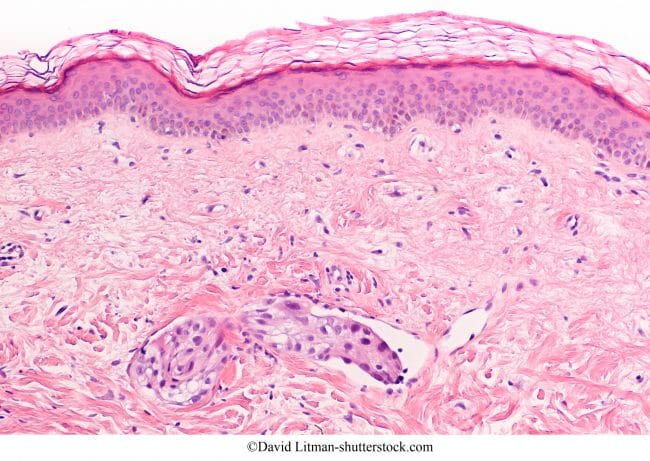 Células cancerosas en los ganglios linfáticos, cáncer de mama