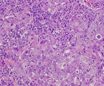 carcinoma medular