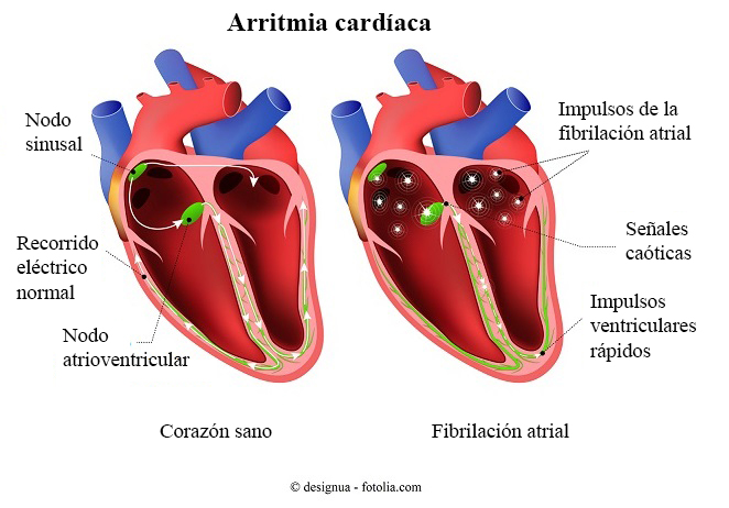 arritmia cardíaca
